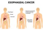 esophagal cancer
