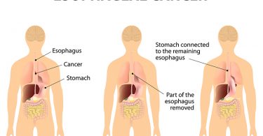 esophagal cancer