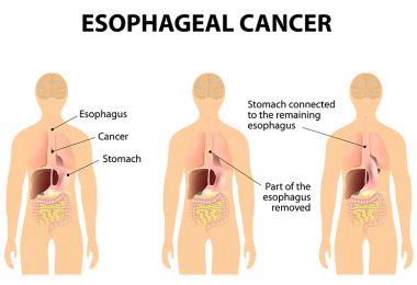 esophagal cancer