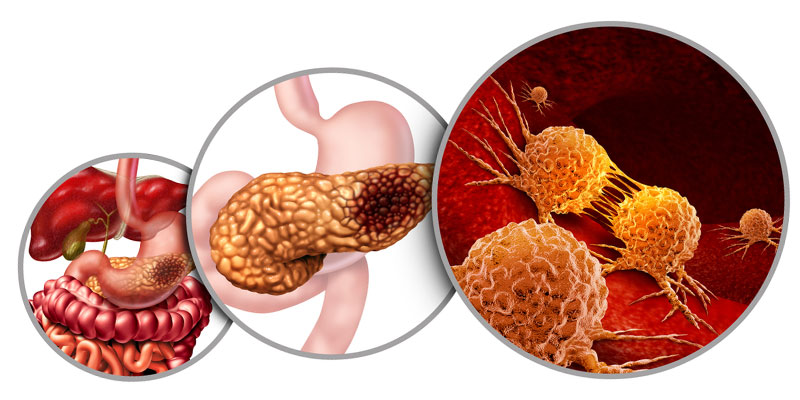 Surgeon For Pancreatic Cancer In Gurgaon