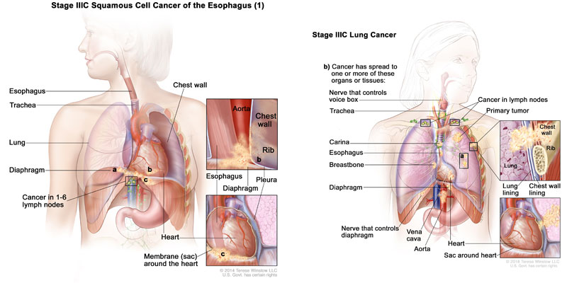 best doctor for chest wall cancer in delhi