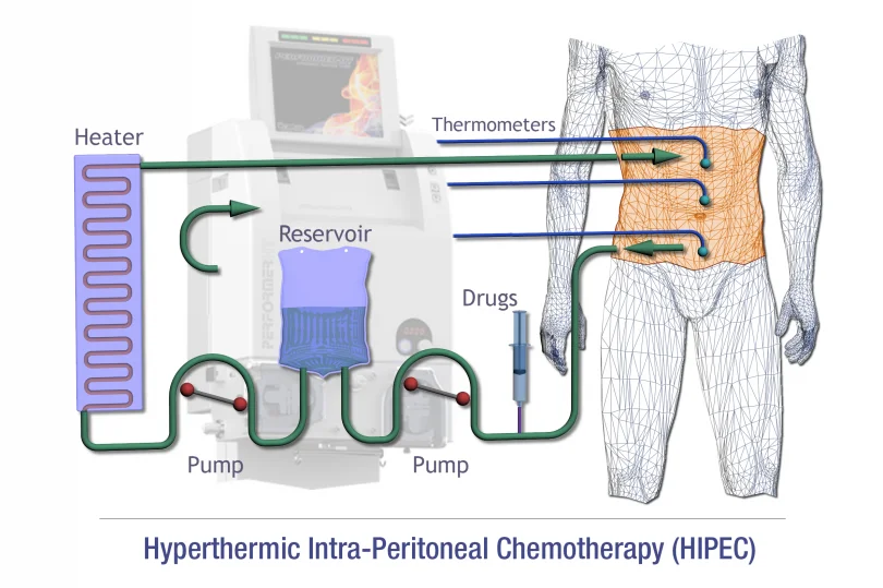 HIPEC Therapy for Ovarian Cancers ,Colon Cancers and Gastric Cancers!