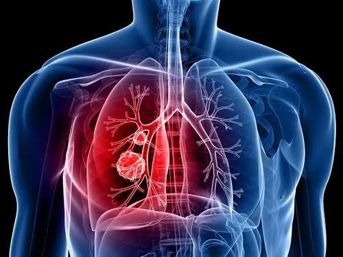Thoracic Cancer Surgery