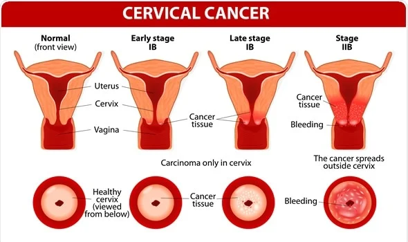 HPV Vaccine (Cervical Cancer vaccination for women)