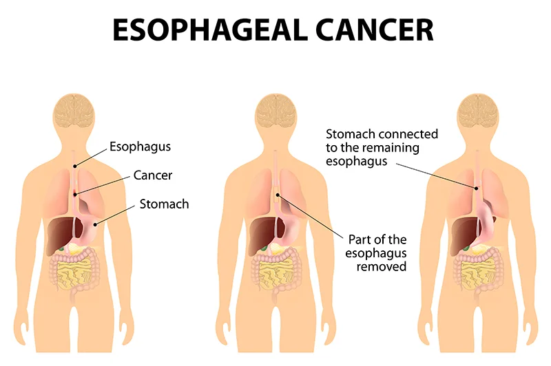 Esophageal Cancer and Tumors Symptoms & Causes