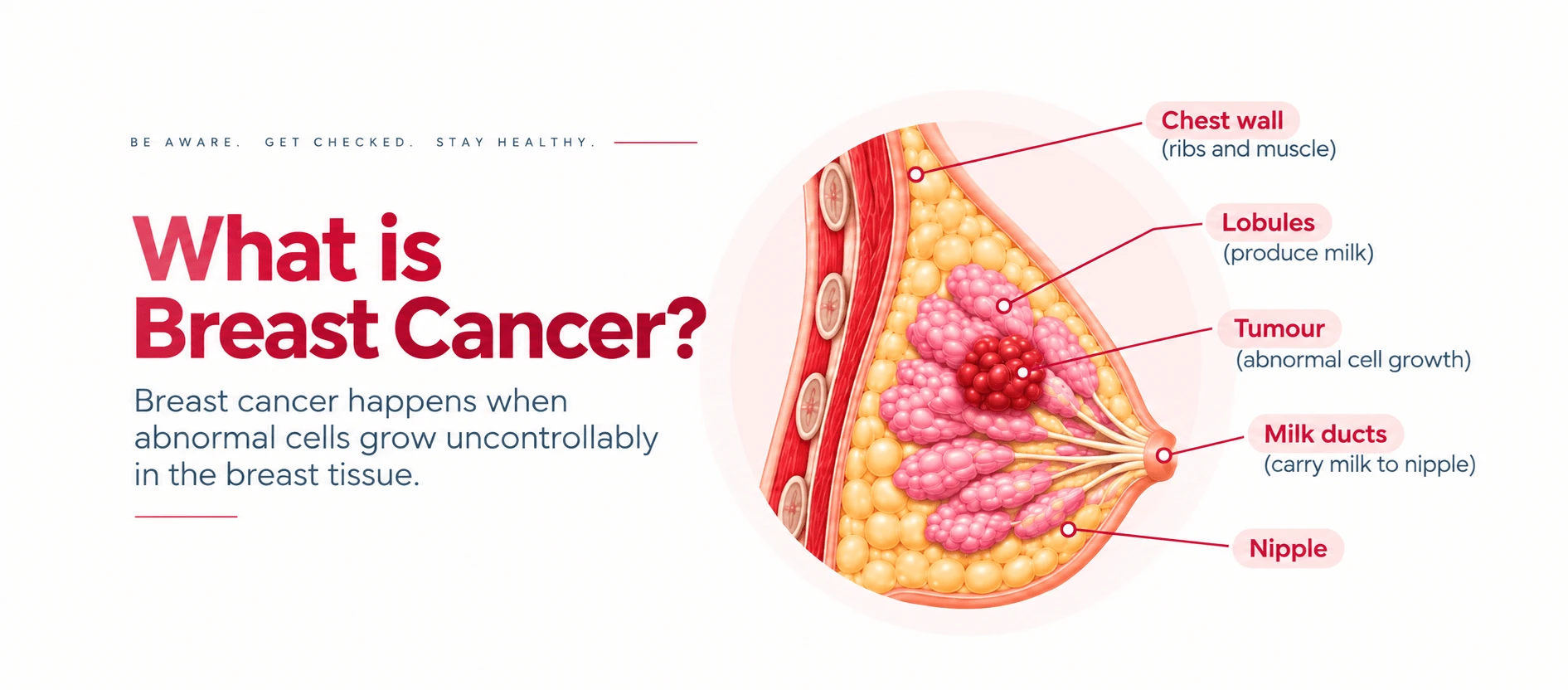 Breast cross-section illustration showing where a tumour forms in relation to the lobules and milk ducts, shared by Dr Archit Pandit