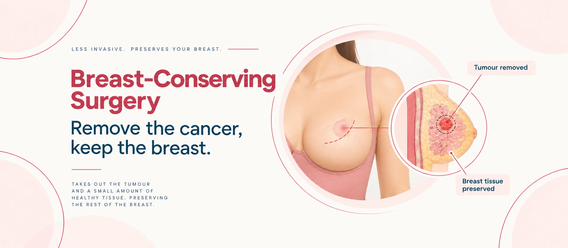 Dr Archit Pandit’s guide to breast-conserving surgery vs mastectomy, showing a woman considering her treatment options next to a breast tumour illustration.