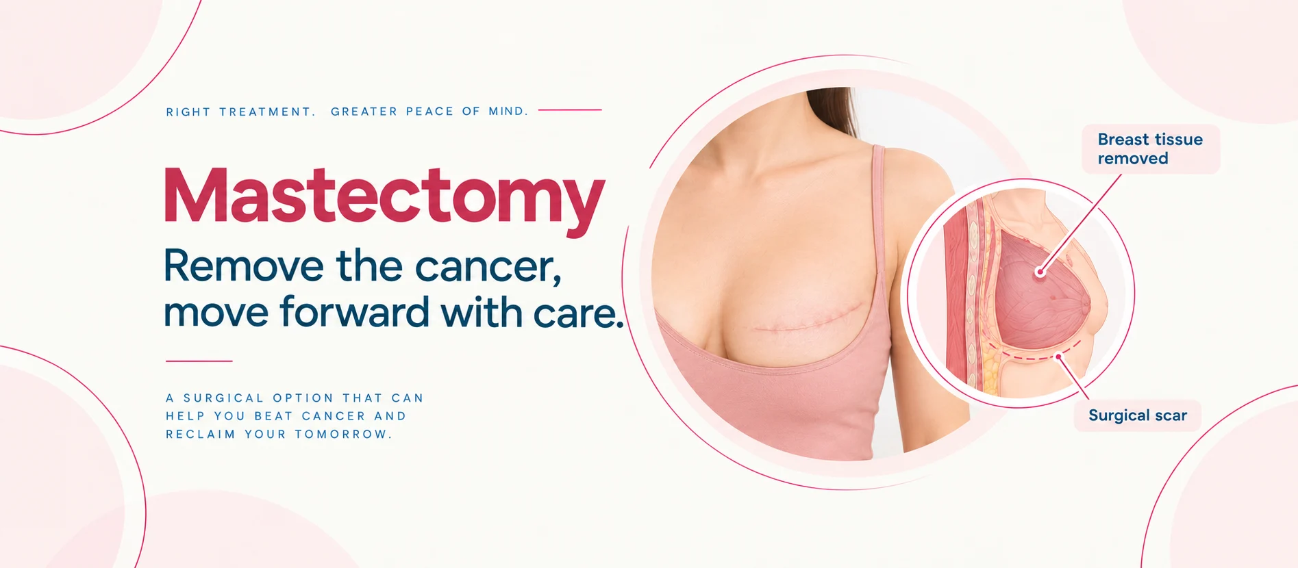 Dr Archit Pandit explains mastectomy: infographic showing a surgical scar after breast removal and a diagram of the breast tissue removed.